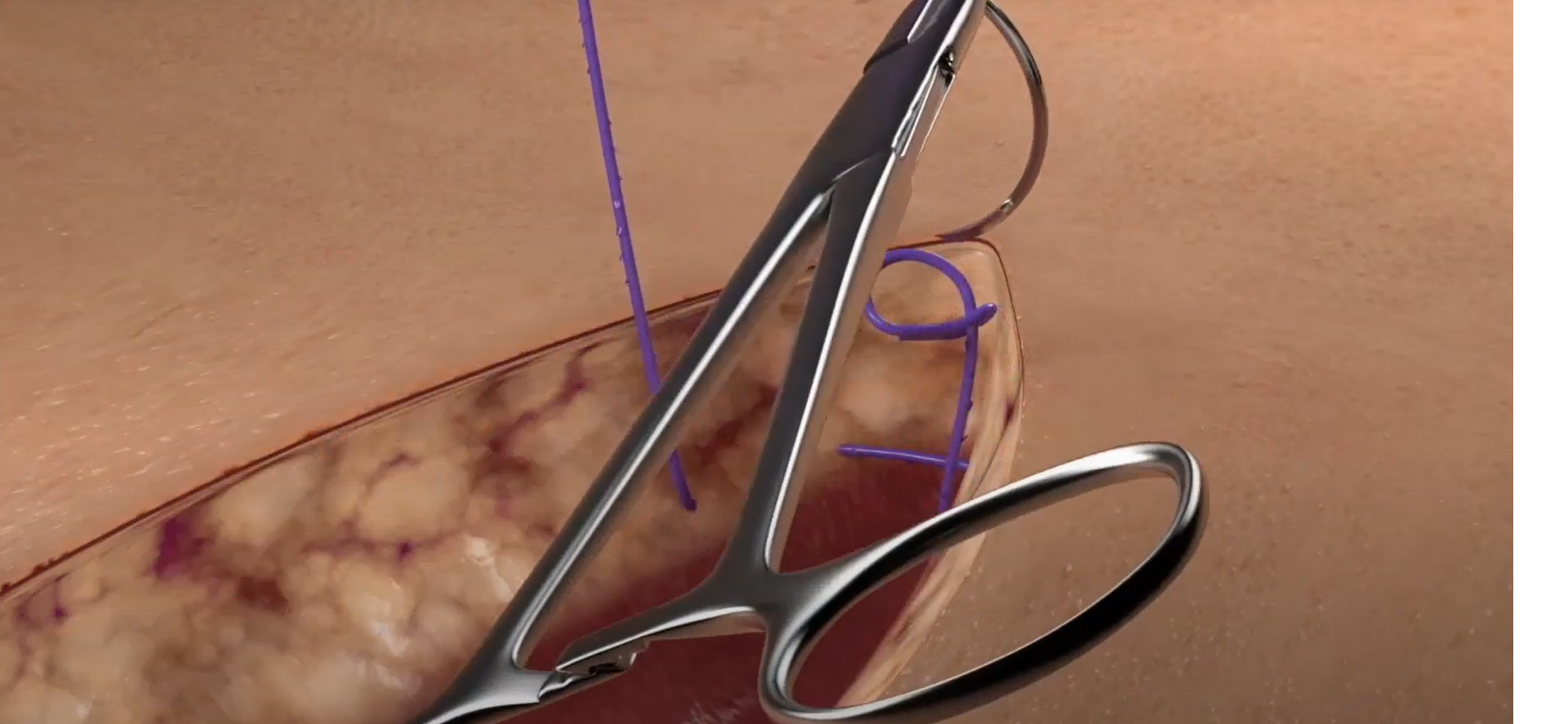 How to use Quill Barbed Suture - Corza Medical