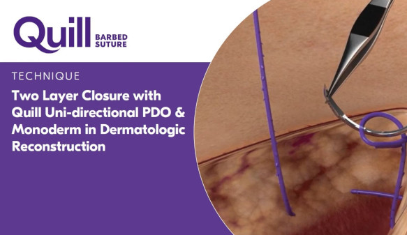 Two layer closure with Quill uni-directional PDO and monoderm