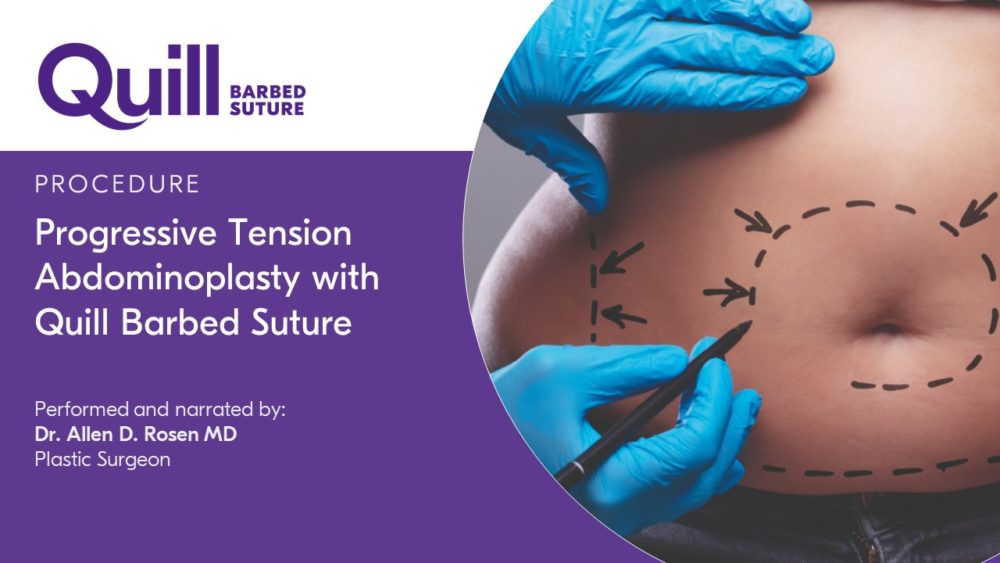 Abdominoplasty Progressive Tension Technique by Dr. Allen Rosen Corza