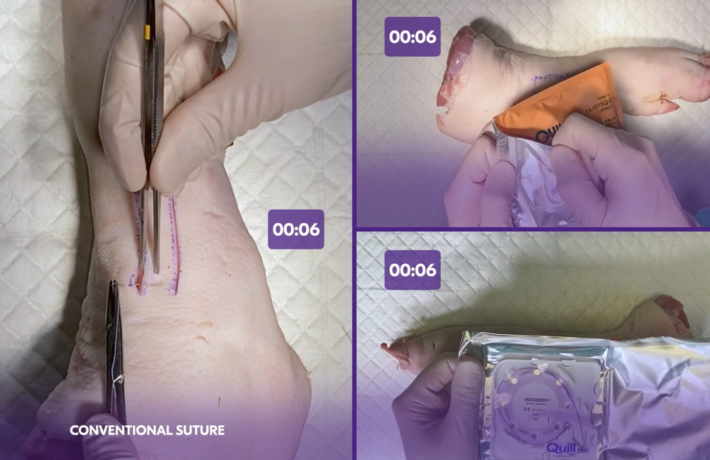 Two layer closure with Quill uni-directional PDO and monoderm